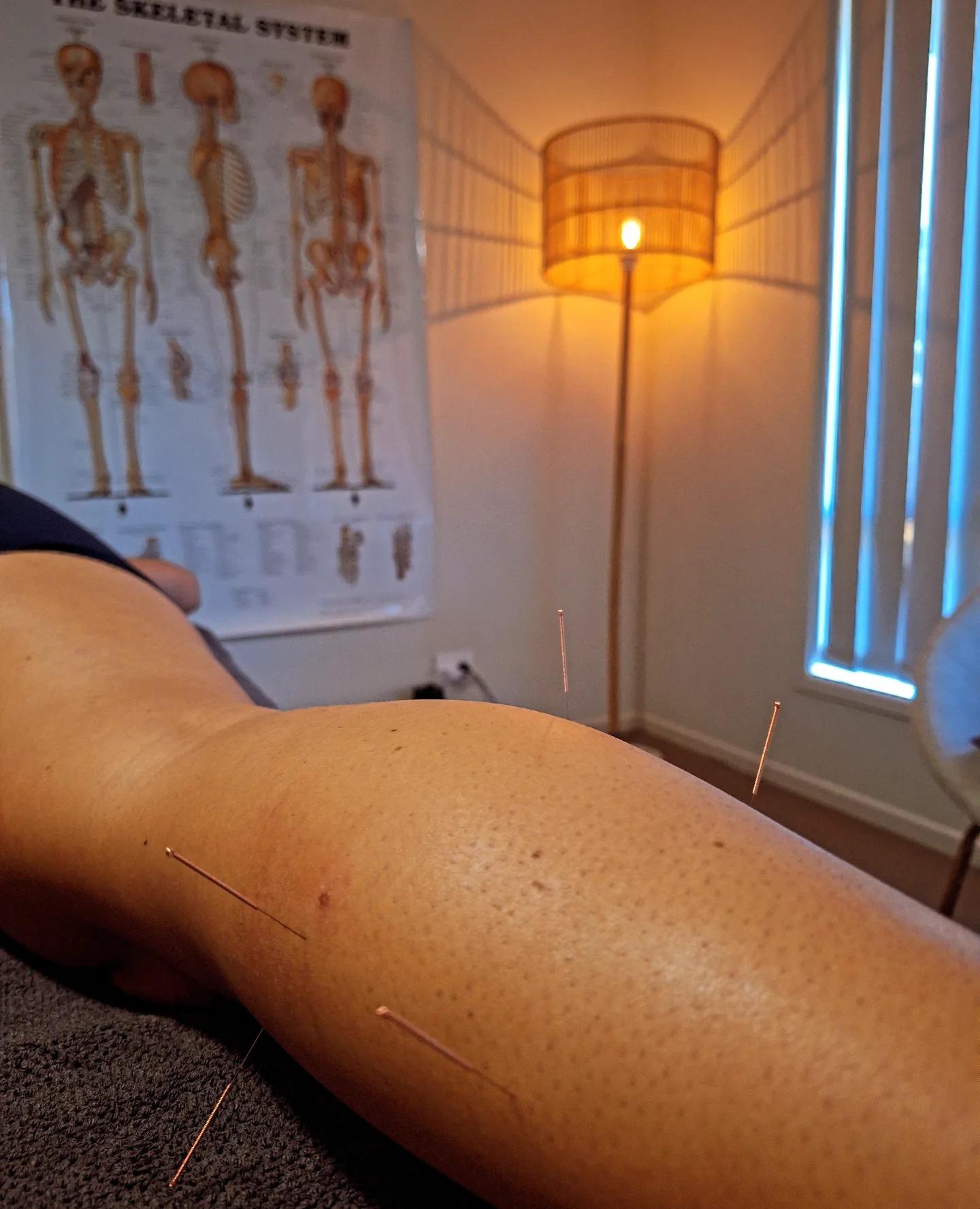 Dry Needling
