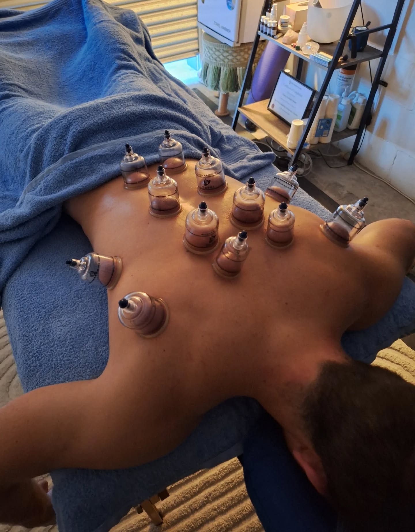 Cupping Therapy